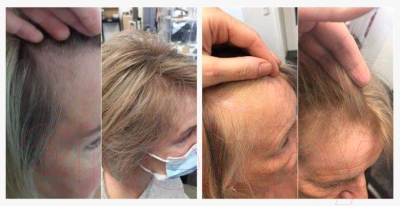 Эссенция для волос Inclip Кислородная 5 от выпадения и для роста волос (20мл)