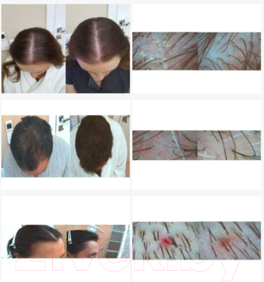Эссенция для волос Inclip Эмульсия Кислородная 5 против выпадения и для роста волос (50мл)