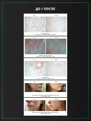 Сыворотка для лица LifeCode Anti-Acne (30мл)