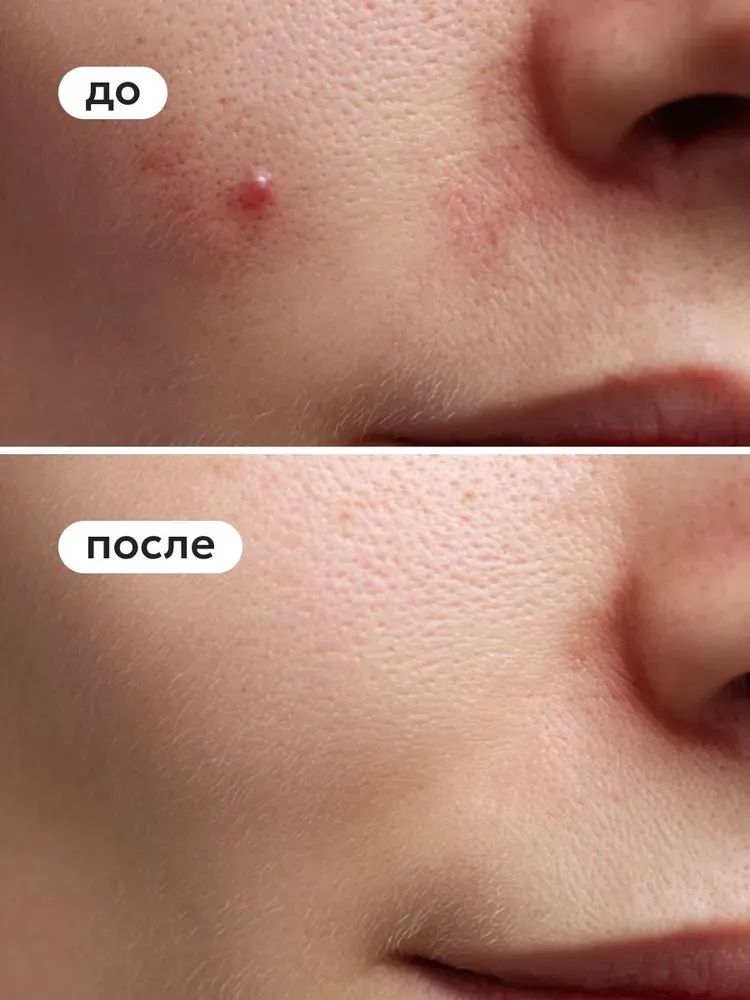 Крем для лица Likato Professional Post Acne Точечный от прыщей и постакне (20мл) — фото 5