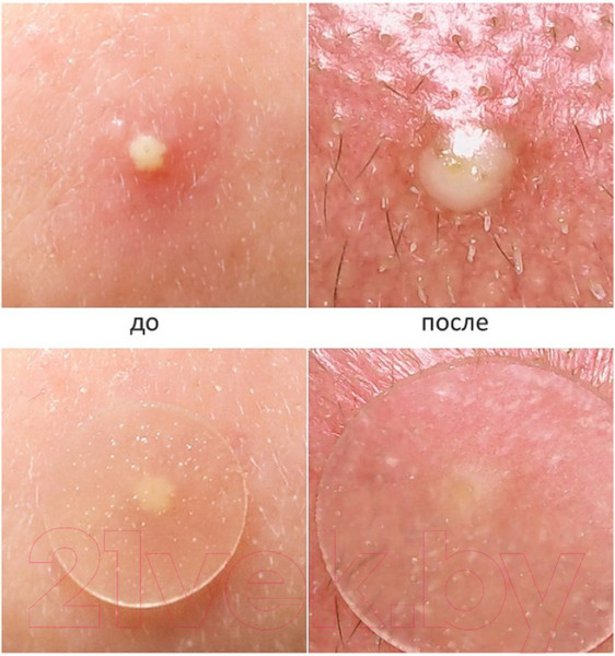 Изображение товара Маска для лица гидрогелевая Elizavecca Witch Piggy Hell-Pore Blemish Spot Patch для проблемной кожи (44шт)